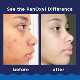 Maximum Strength Benzoyl Peroxide Acne Foaming Cleanser for Clear Skin