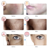 LED Facial Mask for Skin Rejuvenation, Wrinkle Reduction & Acne Treatment