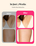 Painless IPL Laser Hair Removal Device for Women & Men – Full Body & Facial Use