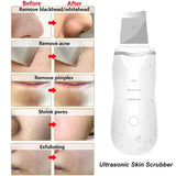 Ultrasonic Skin Scrubber & Blackhead Remover with Ion Deep Pore Cleaner